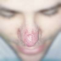 Che fare a causa di pelle grossa tutta la faccia in posti